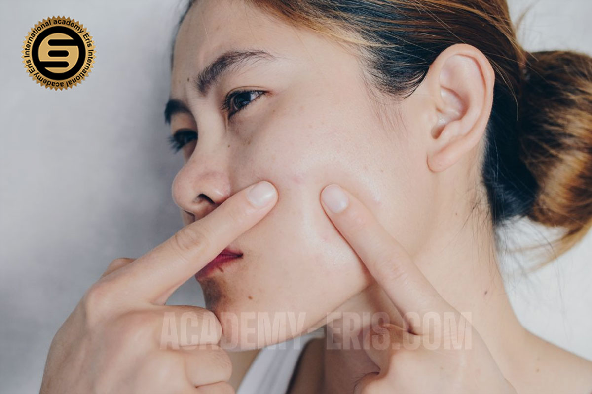 روش های خانگی برای درمان جوش صورت و آکنه